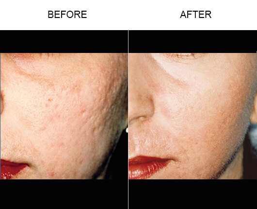Laser Skin Resurfacing Treatment Before And After